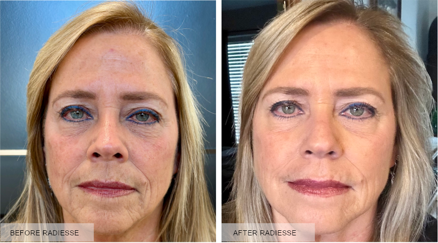 Before after1